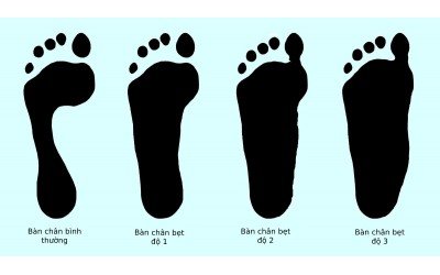 Cách chọn giày theo dáng Chân và Cơ thể