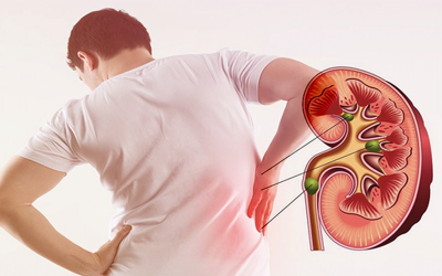 Những thói quen ăn uống dễ khiến hình thành sỏi thận